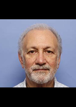 Blepharoplasty after — Dr. Thomas Romo