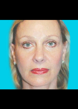 Facelift before and after - after