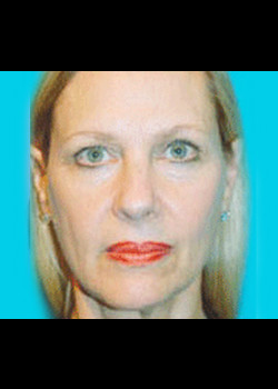 Facelift before and after - before