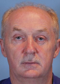 Blepharoplasty after — Dr. Thomas Romo