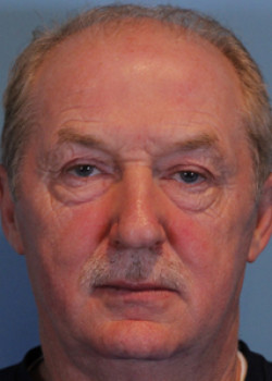 Blepharoplasty before — Dr. Thomas Romo