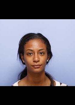 Rhinoplasty before and after - after