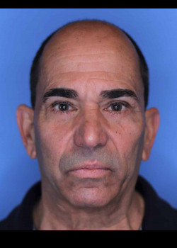 Blepharoplasty after — Dr. Thomas Romo