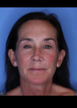 Facelift after — Dr. Thomas Romo