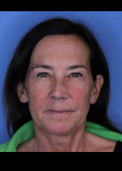 Facelift before — Dr. Thomas Romo