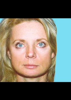 Facelift before and after - after