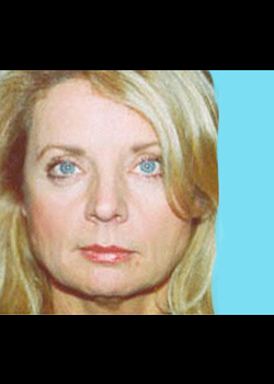 Facelift before and after - before