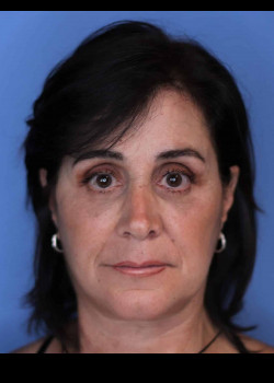 Facelift before and after - after