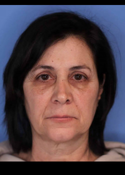 Facelift before and after - before