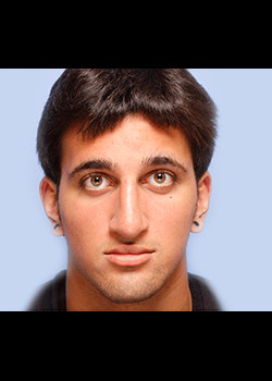 Rhinoplasty before and after - after