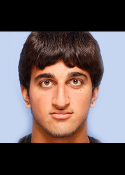 Rhinoplasty before and after - before