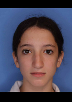 Procedure before and after - before