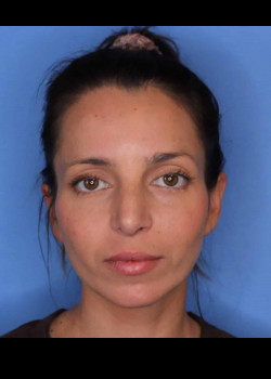 Procedure before and after - after