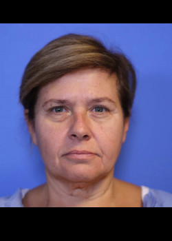 Facelift before — Dr. Thomas Romo