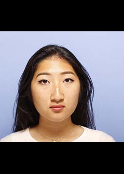 Rhinoplasty before — Dr. Thomas Romo
