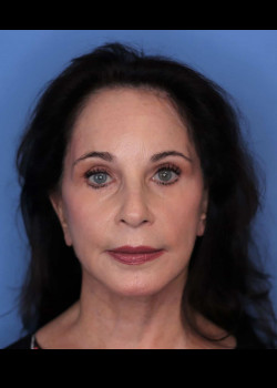 Facelift after — Dr. Thomas Romo