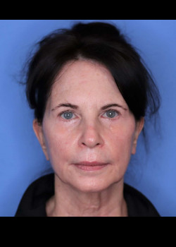 Facelift before — Dr. Thomas Romo