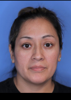 Blepharoplasty after — Dr. Thomas Romo
