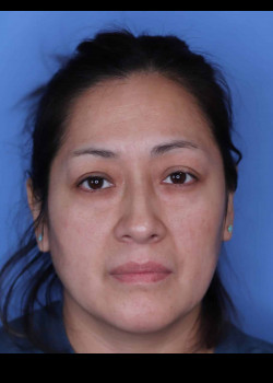 Blepharoplasty before — Dr. Thomas Romo