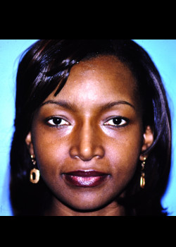 Rhinoplasty before and after - after
