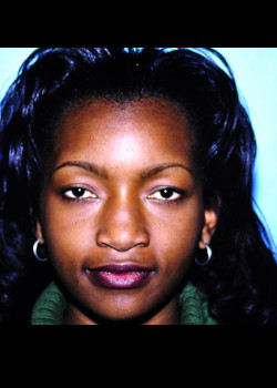 Rhinoplasty before and after - before