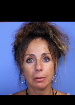 Facelift before and after - after