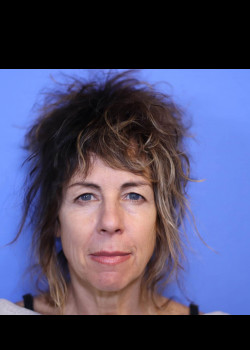 Facelift before and after - before