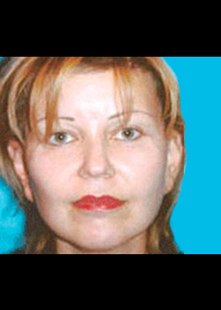 Facelift after — Dr. Thomas Romo