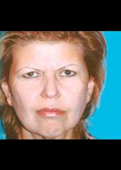 Facelift before — Dr. Thomas Romo