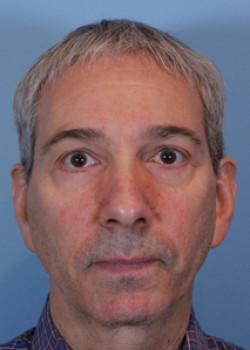 Blepharoplasty before and after - after
