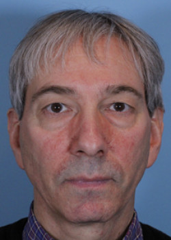 Blepharoplasty before and after - before