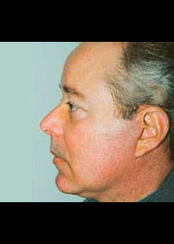 Facelift after — Dr. Thomas Romo