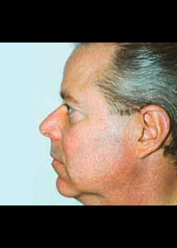 Facelift before — Dr. Thomas Romo
