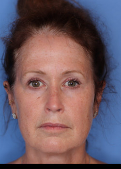 Blepharoplasty after — Dr. Thomas Romo