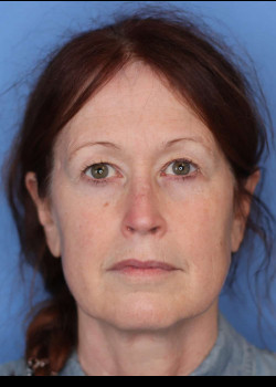 Blepharoplasty before — Dr. Thomas Romo