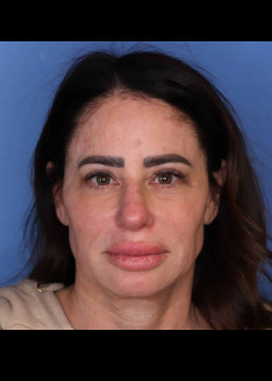 Procedure before and after - before