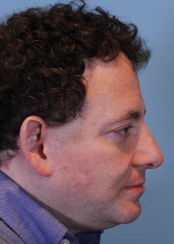 Facelift after — Dr. Thomas Romo