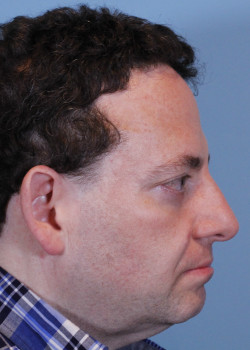 Facelift before — Dr. Thomas Romo