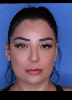 Procedure before and after - after