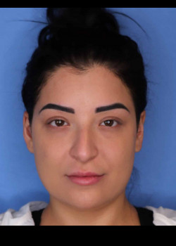 Procedure before and after - before