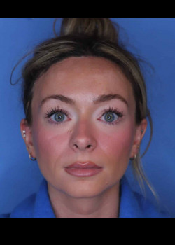 Procedure before and after - after