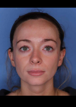 Procedure before and after - before
