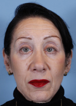 Blepharoplasty after — Dr. Thomas Romo