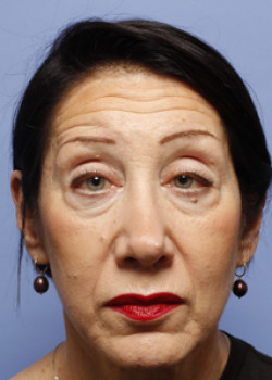 Blepharoplasty before — Dr. Thomas Romo