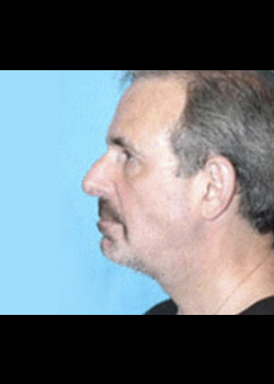 Facelift before and after - after