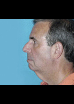 Facelift before and after - before