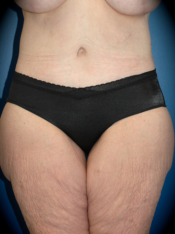 Body Lift before and after - after
