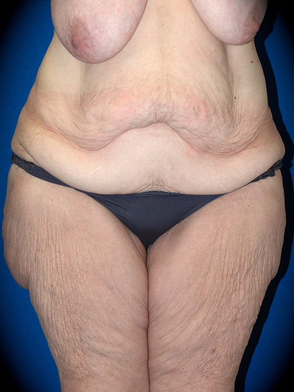 Body Lift before and after - before