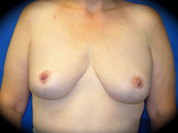 Breast Lift before and after - after