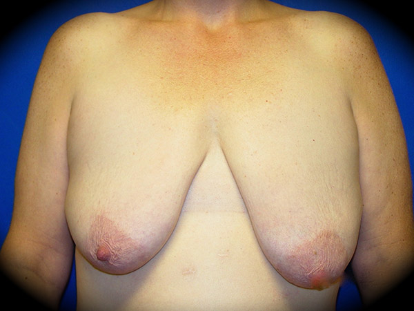 Breast Lift before and after - before
